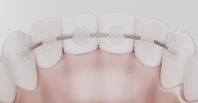 Darstellung von Zähnen mit festsitzendem Dauerrtainer