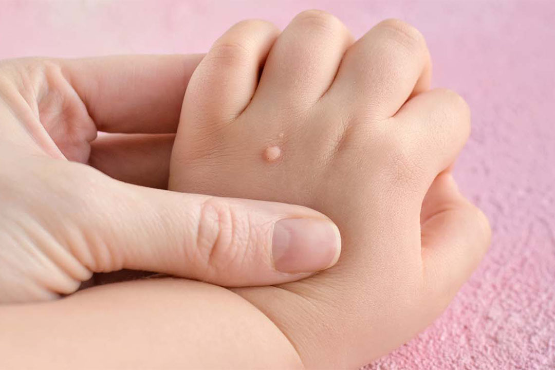 Eine Frau hält die Hand eines Kleinkindes, dass eine Warze auf dem Handrücken hat