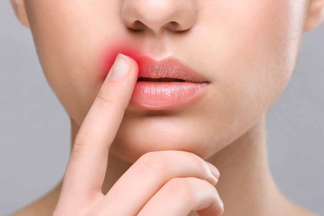 Frau zeigt mit dem Zeigefinger auf ihre gerötete Oberlippe