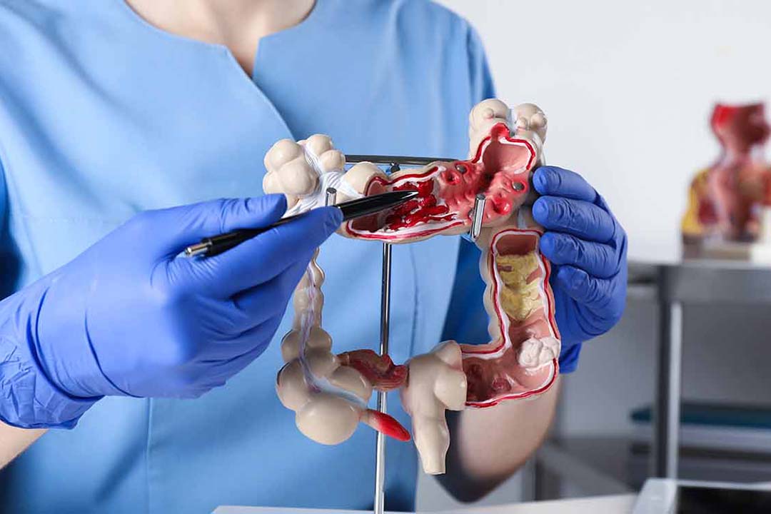 Nahaufnahme Ärztin deutet mit einem Stift auf das Modell eines Darms