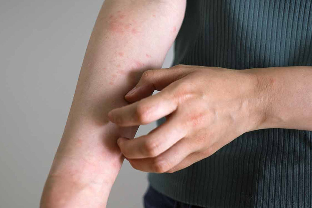 Nahaufnahme - Frau Kratz sich an ihrem gerötetem Arm