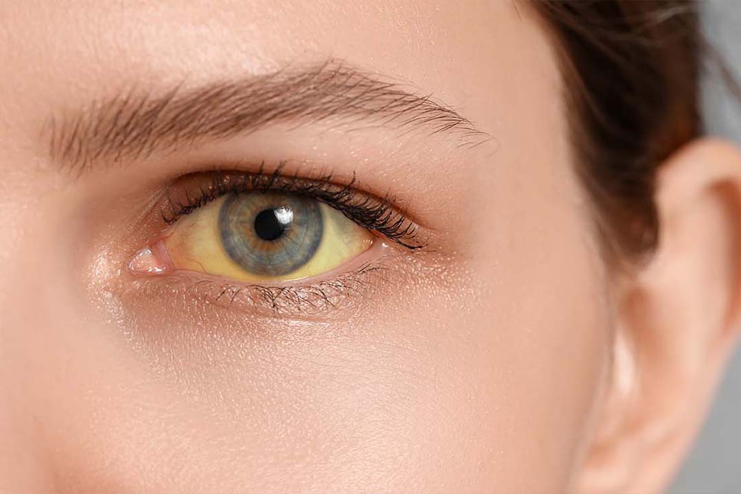 Nahaufnahme eines von Gelbsucht gefaerbten Auges