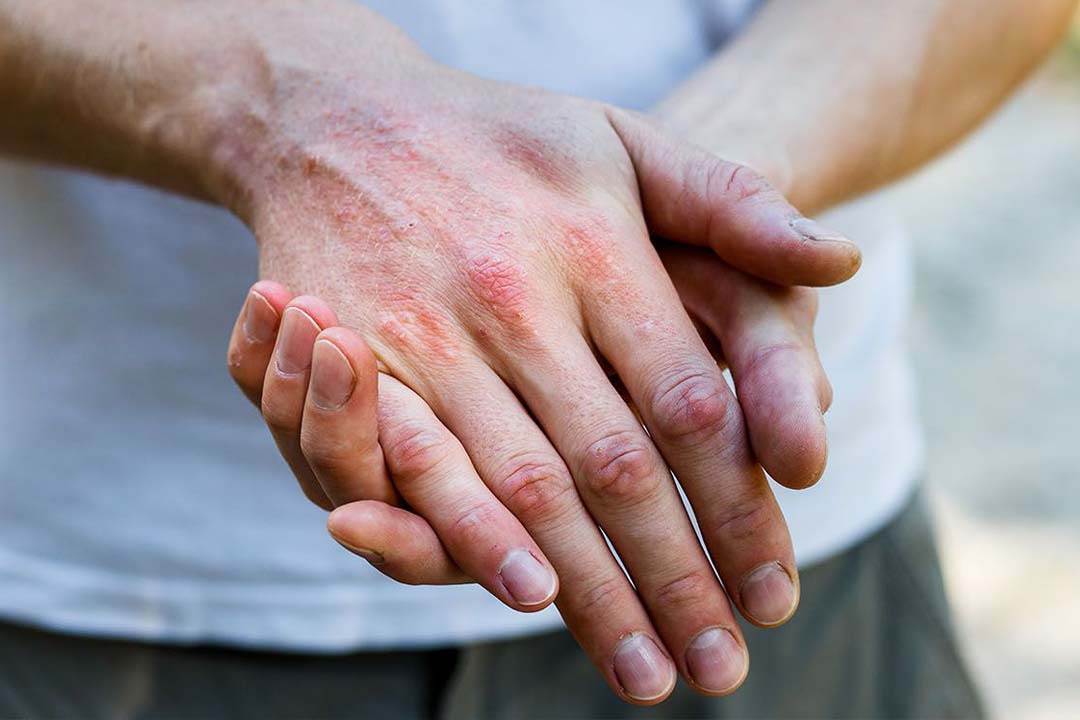 Nahaufnahme geröteter Hände