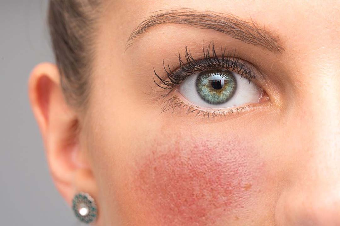 Nahaufnahme einer geröteten Wange