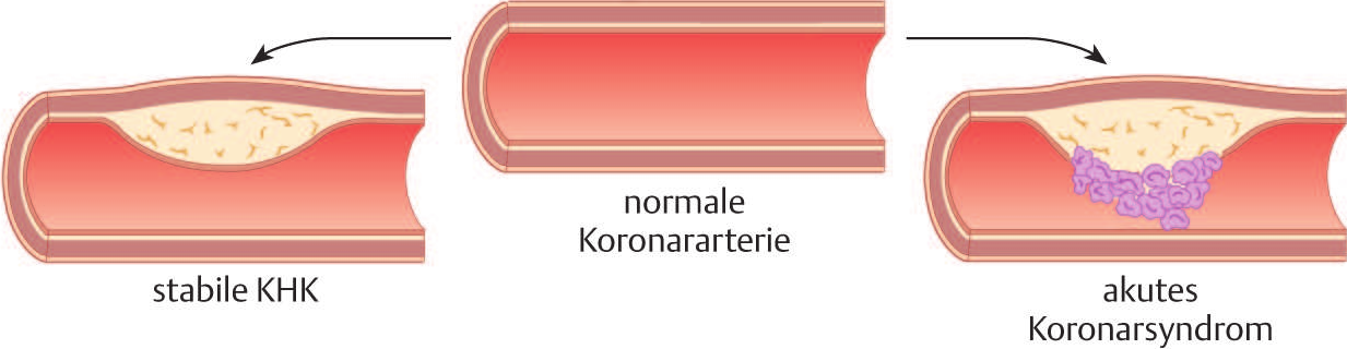 Grafik von Arterien mit normaler Koronararterie, stabiler KHK und akutes Koronarsyndrom